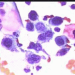 Αδενικά κύτταρα με αρραιοχρωματικούς ανισομεγέθεις πυρήνες, επίχρισμα του 2003